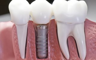 Downtown Toronto Dental Implants