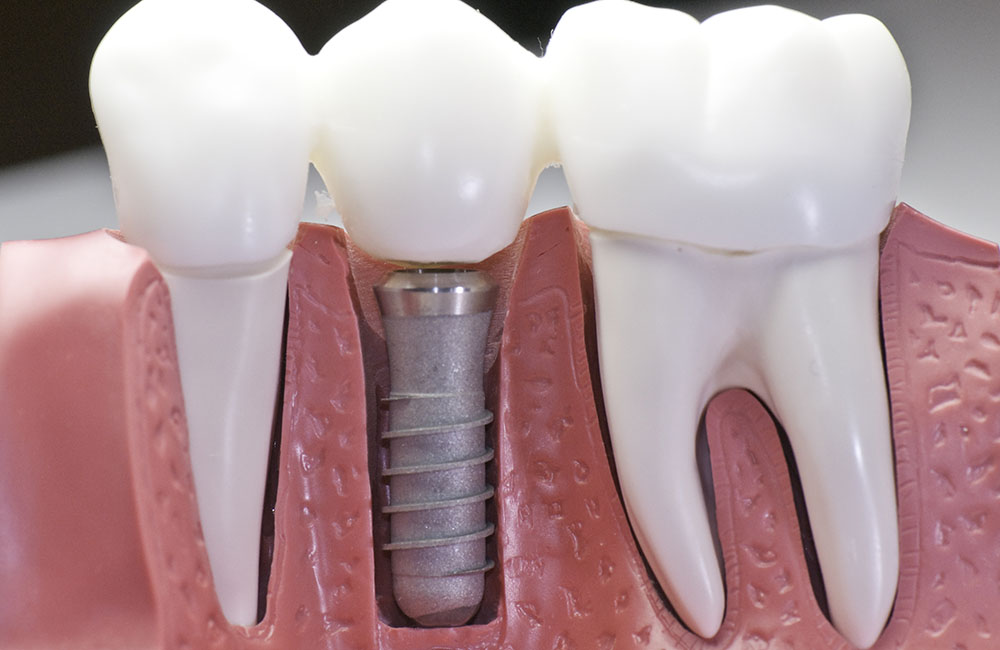 Downtown Toronto Dental Implants