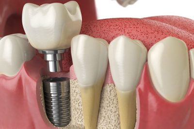 dental-centres-dental-implants-all-on-4